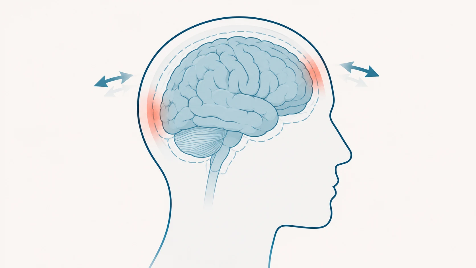 Illustration of the brain inside the skull showing concussion motion