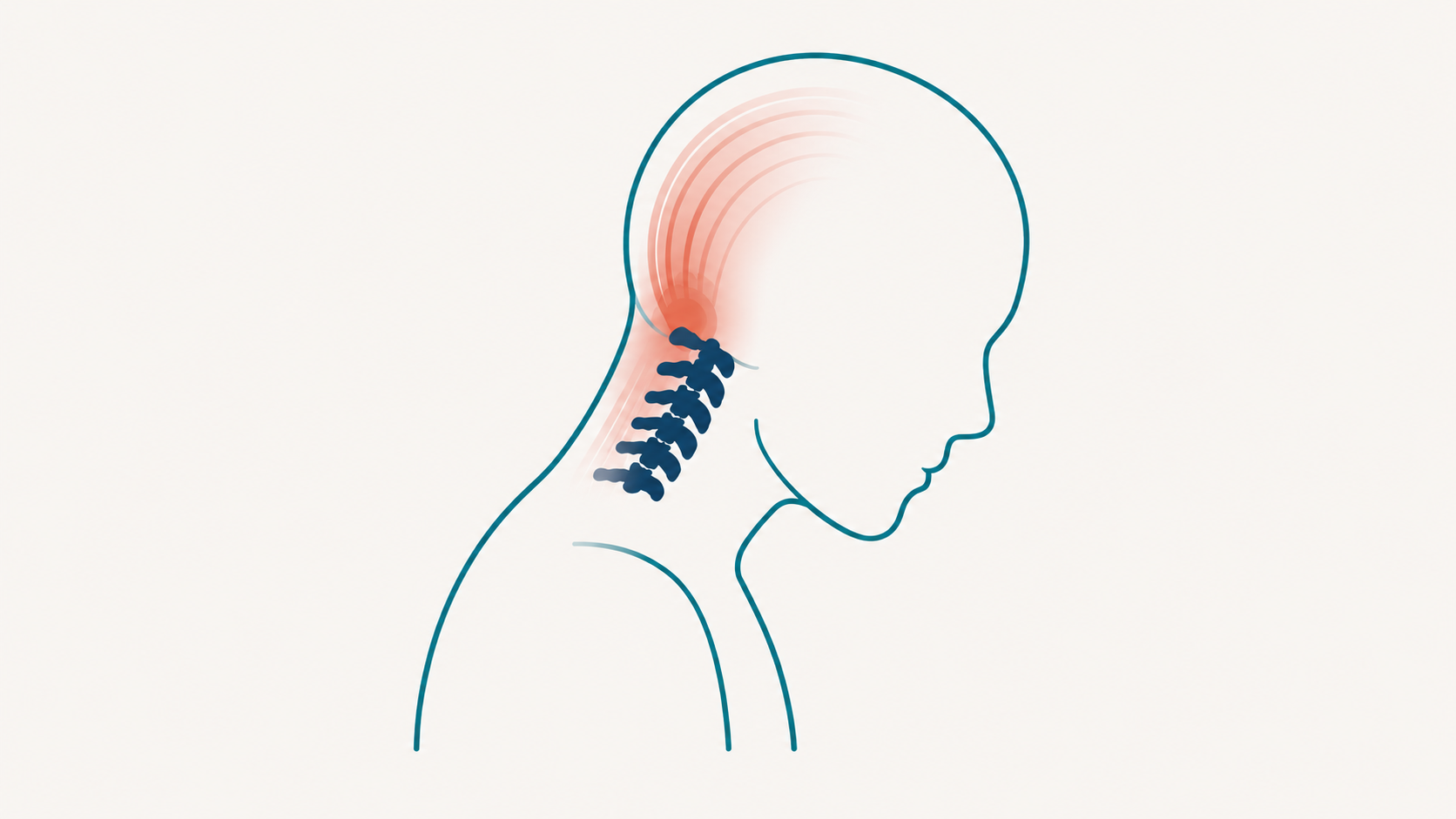 Illustration of a stylized human head and neck showing the cervical spine and a pain pattern radiating from the base of the skull forward into the head
