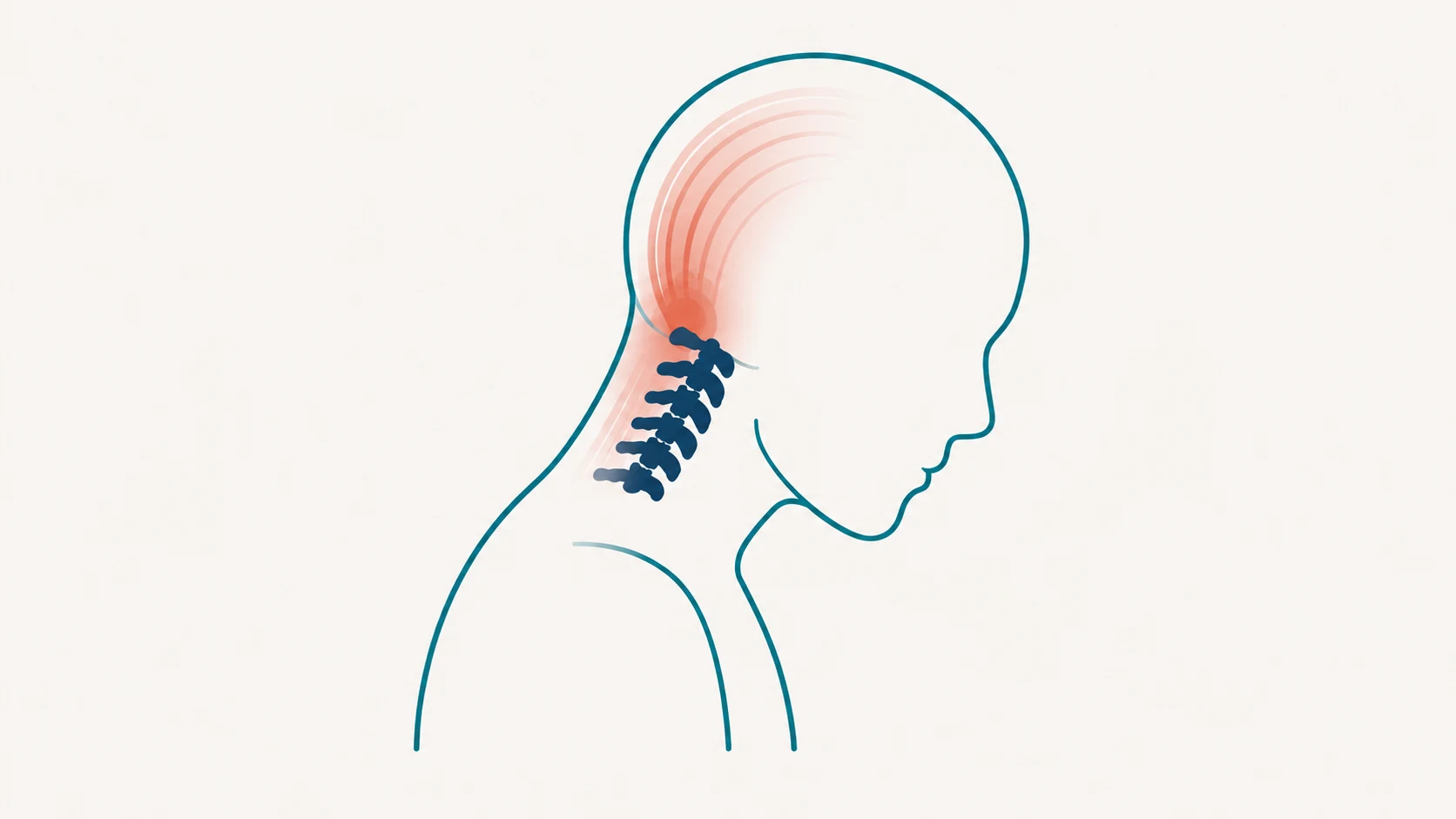 Illustration of a stylized human head and neck showing the cervical spine and a pain pattern radiating from the base of the skull forward into the head