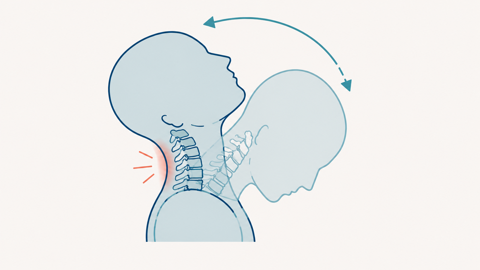 Illustration showing the back-and-forth motion of whiplash